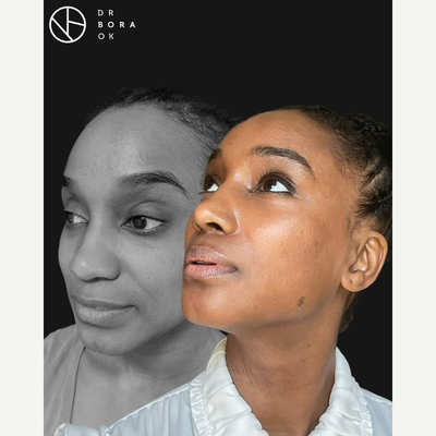 35-44 year old woman treated with African American Rhinoplasty - Post-op 3 months result of my lovely patient and her stunning transformation!I performed ethnicrhinoplasty, tipplasty and alarplasty. Now her nose is more defined and competable with her face.