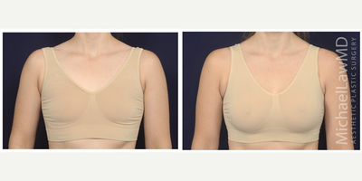 25-34 year old woman treated with Mentor Breast Implants - Breast augmentation. Follow-up photo taken 3 months after the procedure.