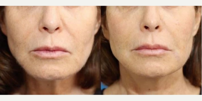 Woman treated with Endolift - Woman treated with Endolift.