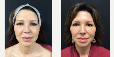 55-64 year old woman treated with Facelift, Facial Fat Transfer, Chemical Peel - AUTOLOGOUS FAT TRANSFER FROM CENTRAL ABDOMEN TO LOWEREYELIDS WITH PLACEMENT OF A TOTAL OF 10 ML AND MINI FACELIFT WITHSMASTECTOMY, CHEMICAL PEEL LOWER LIDS