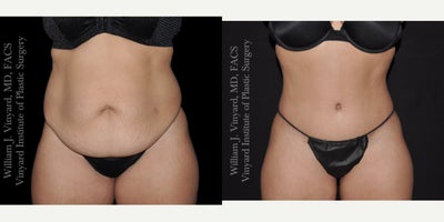 35-44 year old woman treated with Tummy Tuck, Diastasis Recti Repair, Mommy Makeover - This beautiful abdomen makeover showcases what a truly comprehensive abdominoplasty can achieve. By tightening her abdominal muscles, removing excess skin, lifting the mons pubis, and creating a custom-designed, natural-looking belly button, Dr. Vinyard restored a smooth, firm, and balanced contour. Her incision line sits low, thin, and easily concealed beneath intimate clothing  one of the details patients appreciate most about his technique. A stunning transformation with a naturally defined waistline and a confident silhouette.