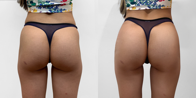 18-24 year old woman treated with Nonsurgical Butt Lift - The patient was treated with 5 syringes of Radiesse in each cheek