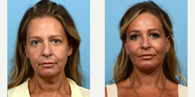 45-54 year old woman treated with Neck Lift, Facelift, Lower Facelift, Chin Implant, Facial Fat Transfer - This 49 year-old-patient wanted to reverse the signs of aging as well as enhance the size of her chin for a more balanced look. Dr. Wise performed both a facelift and neck lift to tighten the skin, as well as a fat transfer to add volume. In addition to this, he performed a chin augmentation to sculpt the patients face and improve her profile. 8 weeks post-op the patient is thrilled with her results and feels like she looks 20 years younger.
