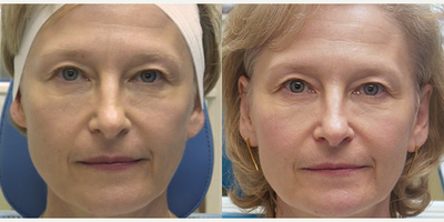 53 year old woman treated with Sculptra - This patient wanted to restore volume in her cheeks