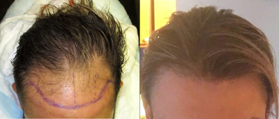 25-34 year old man treated with ARTAS Robotic Hair Transplant - ARTAS