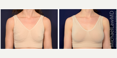 25-34 year old woman treated with Natrelle Breast Implants - Breast augmentation. Follow-up photos taken 3 months after the procedure.