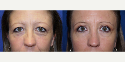 Eyelid Surgery - Patient was tired of being told she looked tired. Pt wanted to look her age and not look older.