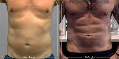 55-64 year old man treated with AirSculpt - This 61-year-old patient received the 48-Hour Six Packa full seven years ago and still has a set of sculpted abs and toned belly to show off!