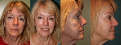 Sculptra - After 3 treatments of Sculptra. One syringe was used each treatment.