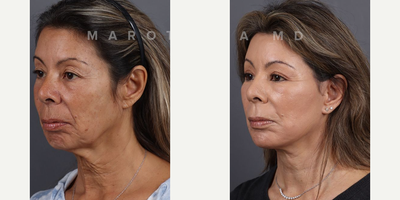 Woman treated with Skin Rejuvenation, Deep Plane Facelift, Neck Lift - Facial rejuvenation with @drjamesmarotta! Swipe left to witness another incredible before and after journey. Dr. Marotta's expertise shines through in these great results, achieved through a combination of deep plane face and neck lift, upper blepharoplasty, perioral dermabrasion, and a chemical peel.Deep Plane Face and Neck Lift: Elevate your beauty to new heights as Dr. Marotta reshapes and rejuvenates facial contours by addressing deeper layers, tackling sagging skin and restoring youthful volume.Upper Blepharoplasty: Open your eyes to a brighter, more refreshed look! Dr. Marotta's precise upper blepharoplasty technique removes excess skin, revealing the true beauty of your gaze.Perioral Dermabrasion: Erase the traces of time around your mouth with perioral dermabrasion. Experience smoother, radiant skin as fine lines and wrinkles fade away.Chemical Peel Magic: Peel back the years with a chemical peel curated by Dr. Marotta. Unveil a radiant complexion, free from imperfections, as the outer layers of your skin are renewed.