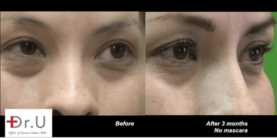 35-44 year old woman Eyelash Transplant using Body Hair / Nape Hair Results - Eyelash Transplant SurgeryMany people want to know how to get thicker eyelashes without the need for false lashes or extensions. This patient wanted her own naturally growing set of long lashes. She chose to undergo Dr. UGraft's eyelash implant surgery This procedure utilizes special technology invented by the doctorto safely extract donor follicles from anywhere on the body. When it comes to eyelash transplantation, thinner hair that matches real lashes can be harvested from the nape area. The sharp growth angles of this hair type make it amenable to damage using regular Follicular Unit Extraction (FUE) punches. However, the doctors Dr.UPunch i is intelligently designed with special features that overcome the issue of challenging hair angles. This engineering makes it possible to easily harvest healthy, robust grafts that can grow and thrive long-term in transplanted areas like the lash line. After extracting donor hair from the patients nape, the doctorused this hair to give this patient the thicker, fuller eyelashes that she hoped for.Three months after the procedure for longer eyelashes, the patient reportedwith her thicker, fuller eyelashes. Additionally, she said that her eyelashes were more even and natural-looking. She started using less mascara and feeling confident about her appearance. Most importantly, (other than the occasional trimming), the patient didnt have to do a lot of maintenance to achieve her desired appearance.