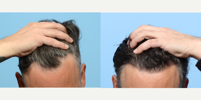 55-64 year old man treated with FUE Hair Transplant, Hair Transplant, Hair Loss Treatment, PRP for Hair Loss - Dr. Wise performed an FUE hair transplant on this patient, transplanting 2,050 grafts to zone 1, in order to bring his receding hairline forward. Additionally, one session of PRP therapy was done to strengthen the follicles and expedite the healing process.