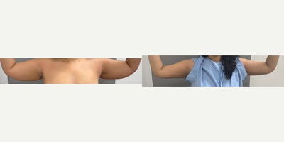 31 yo s/p liposuction of the arms with jplasma/ Renuvion performed under local anesthesia with sedation (twilight anesthesia) in - 31 yo s/p liposuction of the arms with jplasma/ Renuvion performed under local anesthesia with sedation (twilight anesthesia) in our on site AAAA certified operating suite