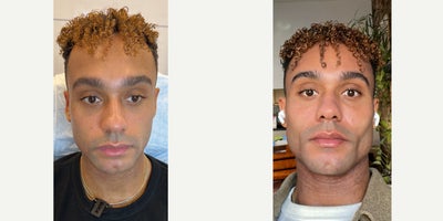 25-34 year old man treated with Cheek Fillers, Chin Filler - Our patient saw us on Instagram and loved how we are able to get the absolute best facial sculpting results. He came to us with specific concerns, such as the hollowness of his under-eyes area. He also desired a stronger jawline and chin. So, we worked our artistry on him, addressing each area with all of our skill and expertise in order to enhance his already great features. We widened his chin, accentuated the angle of his jawline, sharpened his cheeks, and subtly filled his under-eyes, leaving him more than satisfied with the results.