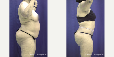 55-64 year old woman treated with Tummy Tuck, Liposuction - Total fat removed: 5050cc.