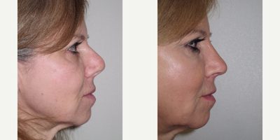 45-54 year old woman revision rhinoplasty - This patient had 2 unsuccessful previous rhinoplasties and was too worried about undergoing a third procedure. I had performed a rhinoplasty on a friend of hers after which she felt more confident about going ahead.
She displayed a polybeak deformity and the nose was too upturned and too short. She also had over -resection of the nose cartilages which needed a reconstruction using grafts.
An open rhinoplasty approach was used to correct the polybeak deformity, Cartilage grafts were used to lengthen the nose and rotate the tip downwards. Tip definition was also achieved with the use of cartilage grafts.