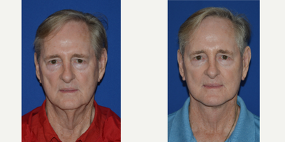 65-74 year old man treated with Facelift - 71 year old male after lateral SMASectomy facelift with platysmaplasty neck lift
