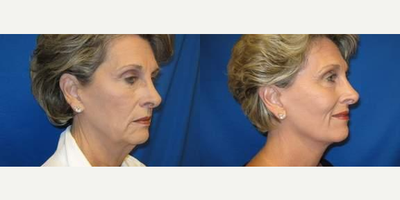 55-64 year old woman treated with Facelift - 55-64 year old woman treated with Facelift