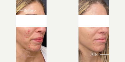 Woman treated with Neo Laser, IPL, Microneedling, Chemical Peel - Woman treated with Neo Laser, IPL, Microneedling, Chemical Peel
