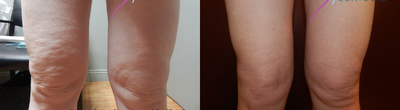 35-44 year old woman treated with Cellulite Treatment - Cellulite treatment 12 treatments with Ultraslim.