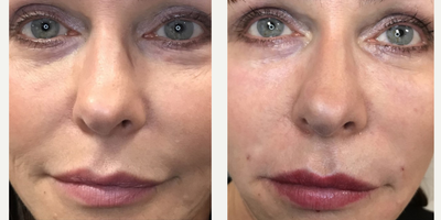 45-54 year old woman treated with Versa Injectable Fillers - Before and immediately after treatment with 2 syringes of Revanesse Versa. Softfill blunt tipped cannula was used to treat tear troughs, nasal labial folds, and lips.