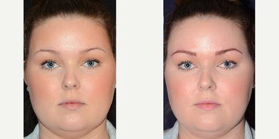 25-34 year old woman treated with Microblading - Microblading treatment of the eyebrows.