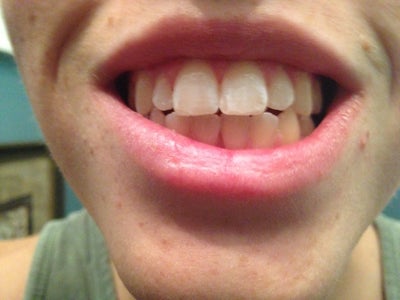 How to fix my flared teeth and narrow smile? (photo) Dentist Answers, Tips