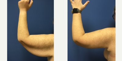 18-24 year old woman treated with Arm Lift - Brachioplasty performed by Dr. Keith Hodge of Monarch Plastic Surgery.