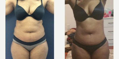 35-44 year old woman treated with Liposuction - Beautiful post op results in this 43 year old patient from Rhode Island two months after 360 liposuction and Brazilian butt lift with Premium Care. Surgical time was minimized using two plastic surgeons, and she spent 8 days after surgery recovering in Cartagena at our five star Recovery Suites. Her figure looks amazing!