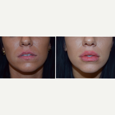 25-34 year old woman treated with Injectable Fillers - This 20 something-year-old female desired fuller lips. Dr. Mitchell injected 1 mL of Juvderm ultra plus XC into the upper and lower lip.  This result is immediately following the injection