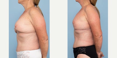 55-64 year old woman treated with Breast Implant Removal, Breast Lift, Breast Fat Transfer, Capsular Contracture Treatment, Ment - 66 year oldRemoval of Bilateral Breast Implants + Mastopexy + Fat GraftingTotal capsulectomy Removal of mentor texture implants intact R)325cc, L)275cc6 weeks po