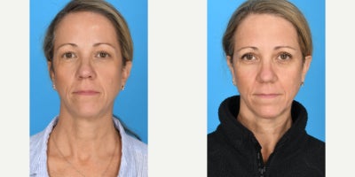 55-64 year old woman treated with Eyelid Surgery - bilateral upper eyelid rejuvenation: blepharoplasty. done in office under local anesthesia