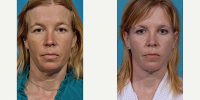 45-54 year old woman treated with Eyelid Surgery, Neck Lift - Necklift with upper eyelid rejuvenation