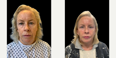 Woman treated with Eyelid Surgery - Woman treated with Eyelid Surgery