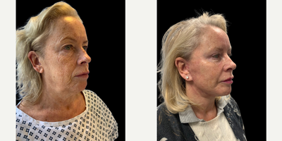 Woman treated with Eyelid Surgery - Woman treated with Eyelid Surgery