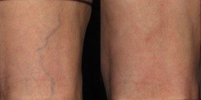 Asclera - 
	Pre and Post Asclera Treatment to the Legs
