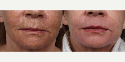 55-64 year old woman treated with Skin Rejuvenation - Hetter Peel to the Peri Oral Region