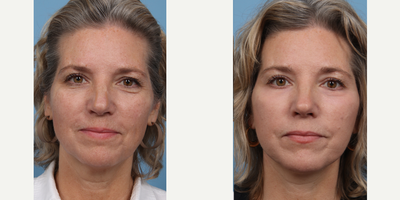 45-54 year old woman treated with Deep Plane Facelift, CO2 Laser - Deep Plane Facelift and Co2 Laser to Lower Eyelids