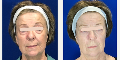 55-64 year old woman treated with Dermal Fillers, Microneedling RF - Under eye bags treated with Agnes RF to shrink them. This was followed 2 months later with under eye HA filler to blend the area.