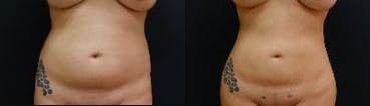 25-34 year old woman treated with Butt Lift - The patient underwent a Brazilian Butt Lift (butt augmentation with liposculpting and fat transfer). The combination of the liposculpting and the fat transfer enhance her butt and overall figure. She has a snatched waist and hourglass figure after her Brazilian Butt Lift.