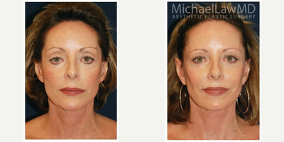 65-74 year old woman treated with Facelift Revision - Full Facial Rejuvenation Revision