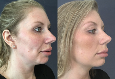 25-34 year old woman treated with Thread Lift - Patient had a Threadlift performed