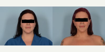25-34 year old woman treated with Renuvion - Neck