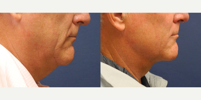 Suspension Suture Neck lift - Suspension Suture Neck Lift