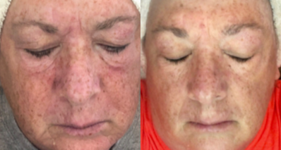 55-64 year old woman treated with DefenAge - 65 y.o. female before and after 4 weeks of Defenage Clinical Trio use.