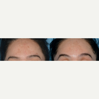 35-44 year old woman treated with LED Skin Treatment - Red and Blue light LED therapy