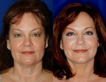 Facial Fat Grafting - 	Facial fat grafts to the malar eminences, nasolabial folds, lips, marionette complex, jawline, in combination with a rhytidectomy (facelift).