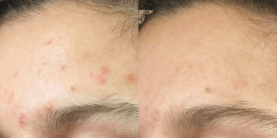 Dilated Pores Treatment using Chemical Peel - Skin pores allow the skin to breathe and to evacuate impurities. They can sometimes become clogged and dilated, giving the skin an irregular appearance. This condition can be effectively treated with chemical peels.