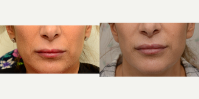 35-44 year old woman treated with Restylane Silk - One of the most trendy, common, non-surgical cosmetic procedures in the United States today is lip augmentation utilizing various fillers. At South Shore Plastic & Reconstructive Surgery, Jonathan Landon, MD, Chief of Plastic and Reconstructive Surgery utilizes Restylane Refyne to perform volumization of you lips. Restylane Refyne causes far less swelling, bruising, and pain then the older Restylane Silk. Additionally, Restylane Refyne is so soft, you cannot even feel the filler in your lips!&nbsp;
