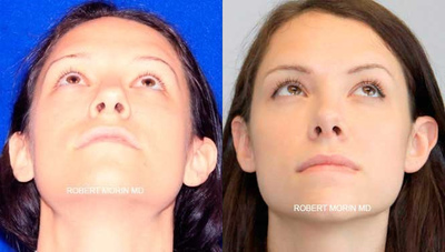 27 year old woman treated with Rhinoplasty - A tip rhinoplasty was performed on this 27 year old female who was unhappy with the appearance of her nose. Surgical correction of her bulbous tip was performed.